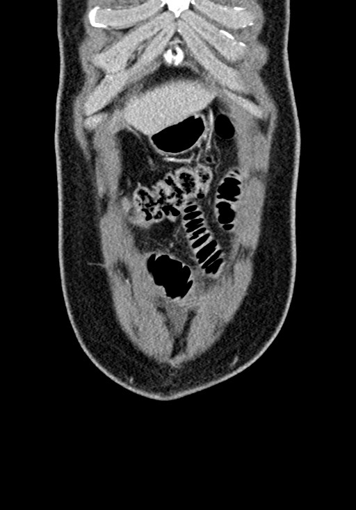 Adhesional small bowel obstruction (Radiopaedia 58900-66131 Coronal C+ portal venous phase 66).jpg