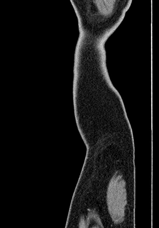 Adhesional small bowel obstruction (Radiopaedia 58900-66131 Sagittal C+ portal venous phase 252).jpg