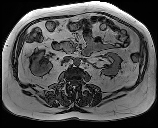 File:Adrenal cortical carcinoma (Radiopaedia 64017-72770 Axial T1 out-of-phase 42).jpg