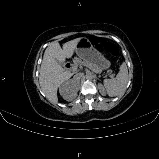 File:Adrenal cortical carcinoma (Radiopaedia 84882-100379 Axial non-contrast 26).jpg
