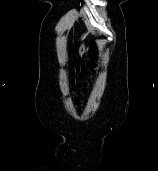 Adrenal cortical carcinoma (Radiopaedia 84882-100379 Coronal C+ portal venous phase 3).jpg