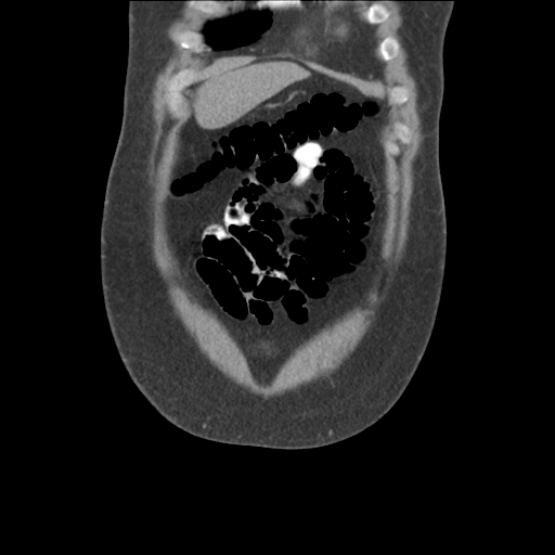 Adrenal cyst (Radiopaedia 45625-49776 Coronal C+ portal venous phase 15).png