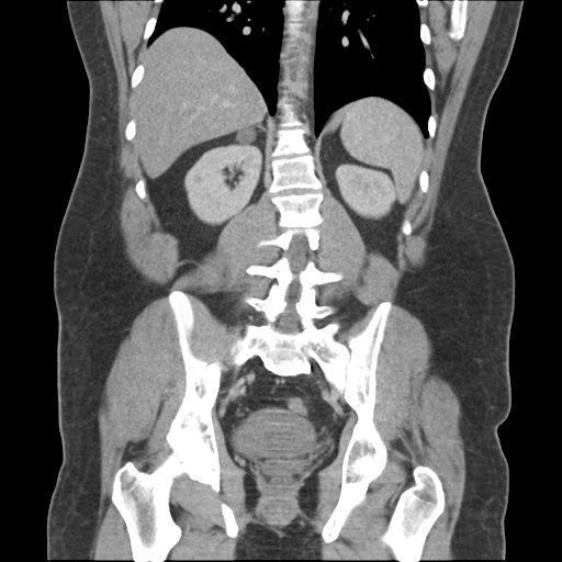 Adrenal cyst (Radiopaedia 45625-49776 Coronal C+ portal venous phase 50).png