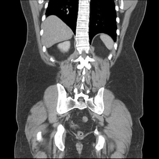 Adrenal cyst (Radiopaedia 45625-49776 Coronal C+ portal venous phase 55).png