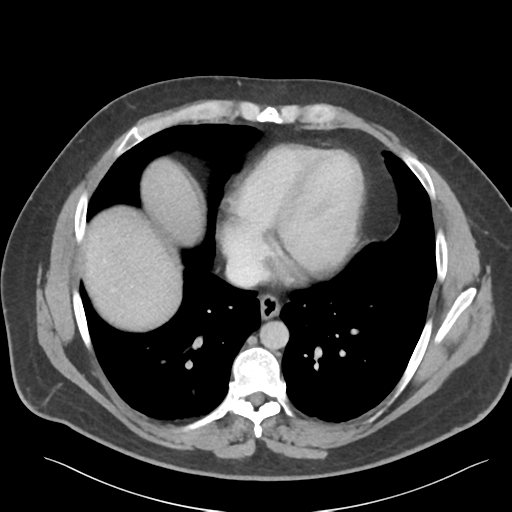 Adrenal cyst (Radiopaedia 45625-49777 Axial C+ portal venous phase 11).png