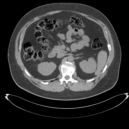 File:Adrenal cyst (Radiopaedia 45625-49778 Axial non-contrast 41).png
