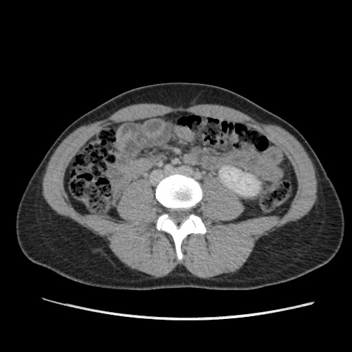 Adrenal cyst (Radiopaedia 64869-73813 Axial C+ portal venous phase 45).jpg