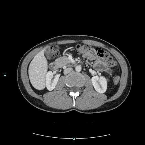 Adrenal cystic lymphangioma (Radiopaedia 83161-97534 Axial C+ portal venous phase 41).jpg