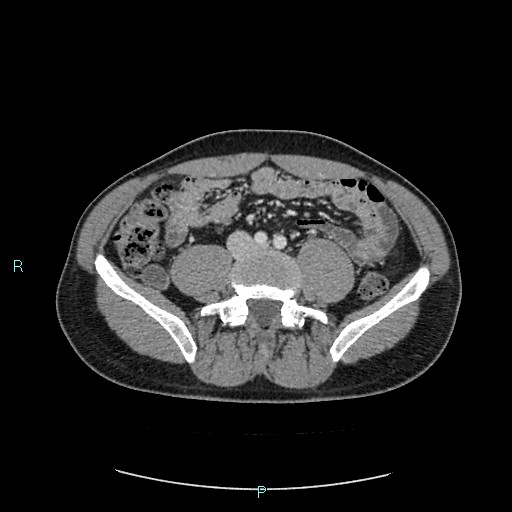 Adrenal cystic lymphangioma (Radiopaedia 83161-97534 Axial C+ portal venous phase 62).jpg