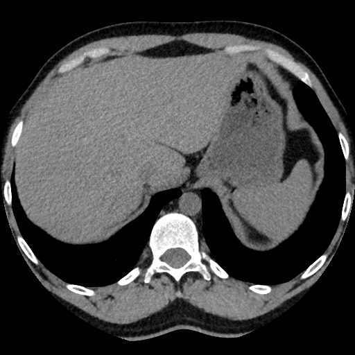 Adrenal gland trauma (Radiopaedia 81351-95079 Axial non-contrast 19).jpg