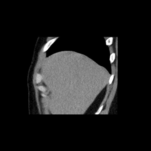 Adrenal gland trauma (Radiopaedia 81351-95079 Sagittal non-contrast 12).jpg