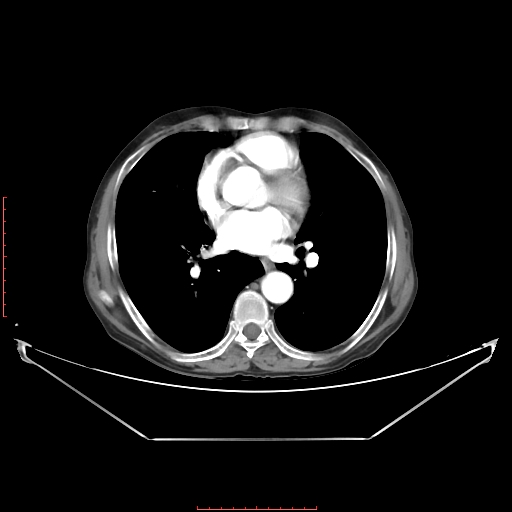 Adrenal hemangioma (Radiopaedia 68923-78668 Axial C+ arterial phase 3).jpg