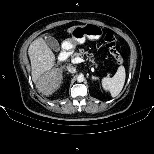 Adrenal hemorrhage (Radiopaedia 62622-70916 Axial C+ portal venous phase 62).jpg