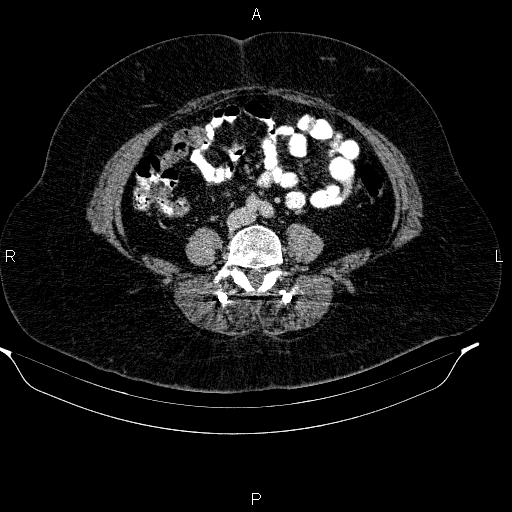 Adrenal myelolipoma (Radiopaedia 84319-99617 Axial renal cortical phase 71).jpg