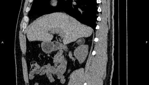 File:Adrenal myelolipoma (Radiopaedia 84321-99619 Sagittal non-contrast 41).jpg