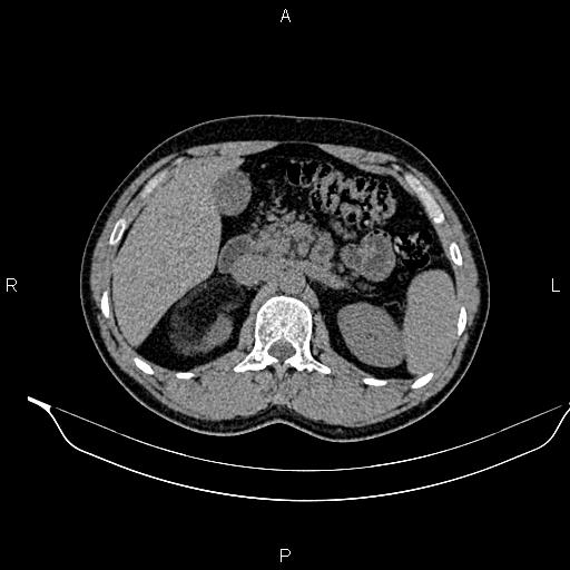 Adrenal myelolipoma (Radiopaedia 87794-104246 Axial non-contrast 38).jpg