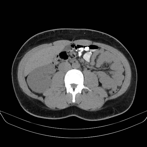 Adrenal myelolipoma - bilateral (Radiopaedia 74805-85810 Axial non-contrast 40).jpg