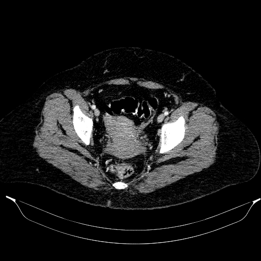 File:Afferent loop syndrome - secondary to incarcerated trocar site hernia (Radiopaedia 82959-97305 Axial C+ portal venous phase 211).jpg