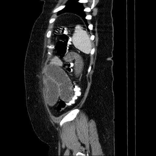 Afferent loop syndrome - secondary to incarcerated trocar site hernia (Radiopaedia 82959-97305 Sagittal C+ portal venous phase 21).jpg