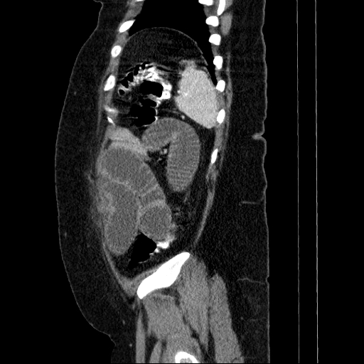 File:Afferent loop syndrome - secondary to incarcerated trocar site hernia (Radiopaedia 82959-97305 Sagittal C+ portal venous phase 24).jpg