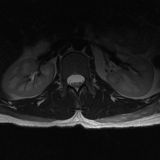 File:Aggressive vertebral hemangioma (Radiopaedia 39937-42404 Axial T2 1).png