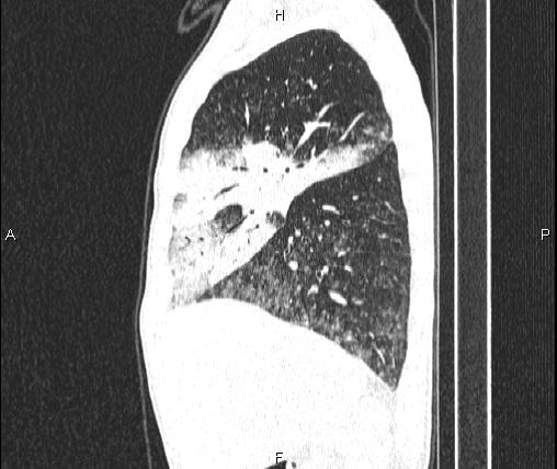 Air bronchogram in pneumonia (Radiopaedia 85719-101512 Sagittal lung window 30).jpg