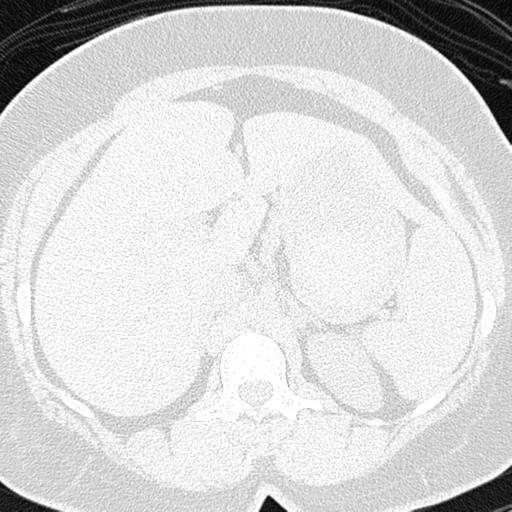 File:Air trapping in small airway disease (Radiopaedia 61685-69694 Axial lung window 211).jpg