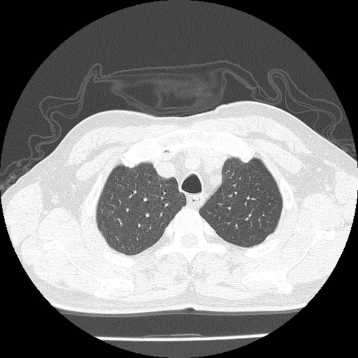 Airway foreign body in adult (Radiopaedia 85907-101779 Axial lung window 14).jpg