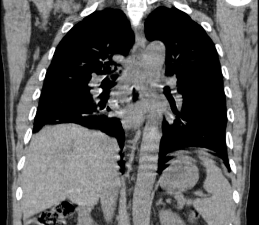 Airway foreign body in adult (Radiopaedia 85907-101779 Coronal liver window 165).jpg