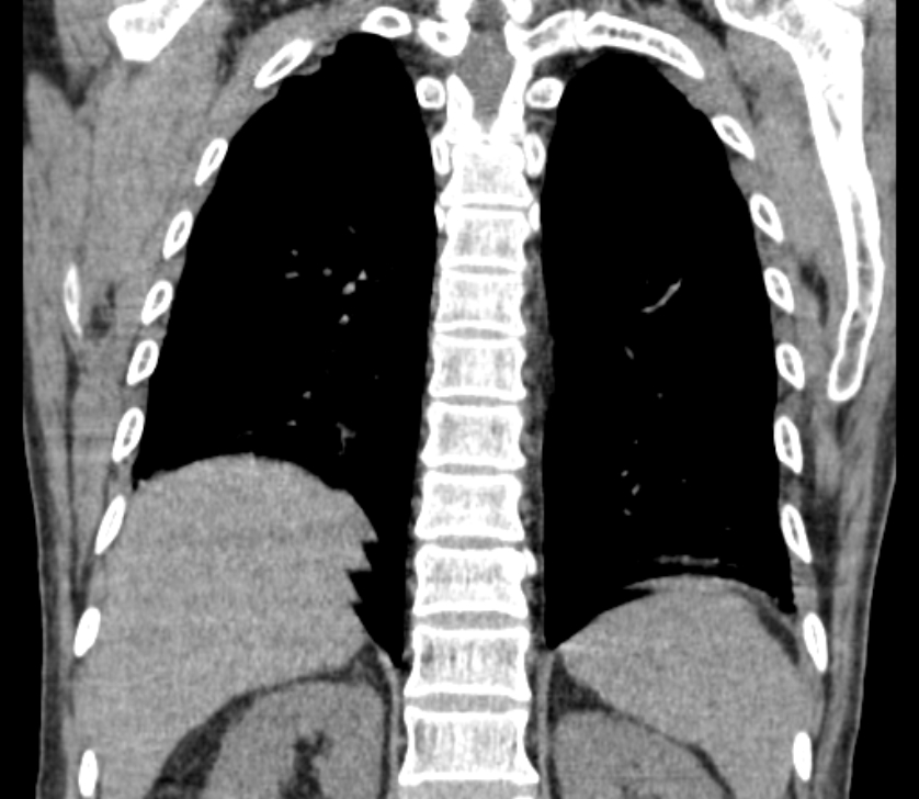 Airway foreign body in adult (Radiopaedia 85907-101779 Coronal liver window 205).jpg