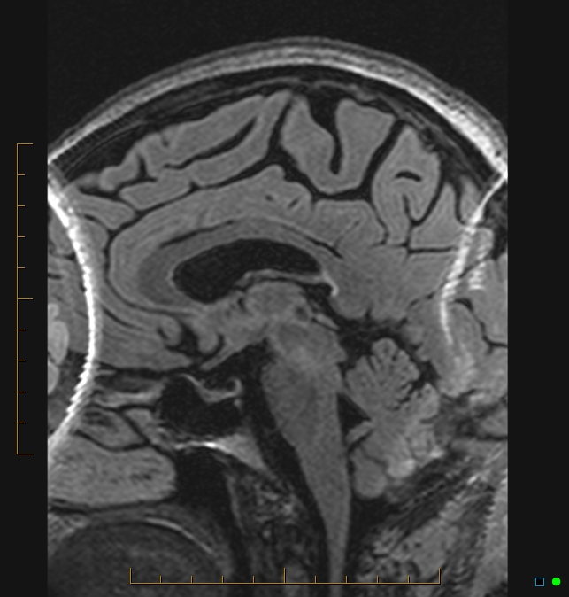 Aliasing artifact causing a spurious cerebellar lesion (Radiopaedia 48783-53810 Sagittal FLAIR 40).jpg