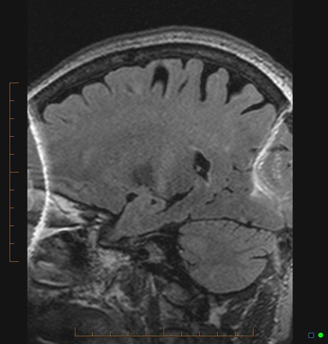 Aliasing artifact causing a spurious cerebellar lesion (Radiopaedia 48783-53810 Sagittal FLAIR 77).jpg