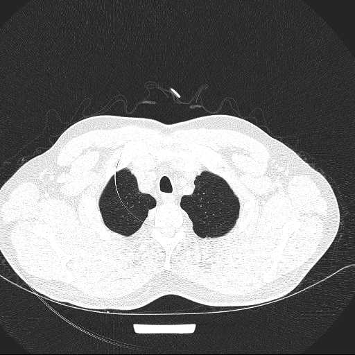 File:Allergic bronchopulmonary aspergillosis (Radiopaedia 21386-21320 Axial lung window 3).jpg