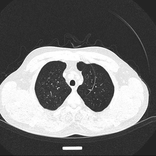 File:Allergic bronchopulmonary aspergillosis (Radiopaedia 21386-21320 Axial lung window 6).jpg