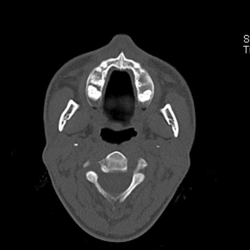 File:Allergic fungal sinusitis (Radiopaedia 29086-29455 Axial bone window 2).jpg