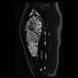 Alveolar soft part sarcoma (Radiopaedia 64501-73678 D 82).jpg