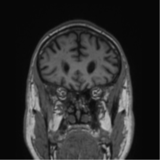 File:Alzheimer's disease- with Gerstmann syndrome and dressing apraxia (Radiopaedia 54882-61150 Coronal T1 68).png