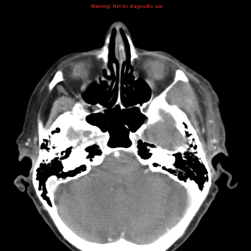 Ameloblastoma (Radiopaedia 27437-27631 A 5).jpg