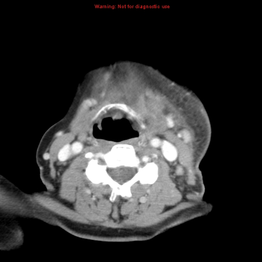 Ameloblastoma (Radiopaedia 27437-27631 A 58).jpg