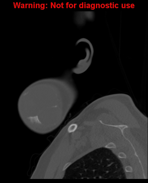 Ameloblastoma (Radiopaedia 33126-34164 Sagittal bone window 11).jpg