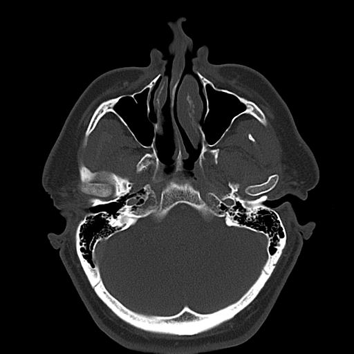 Ameloblastoma (Radiopaedia 38520-40623 Axial bone window 14).png