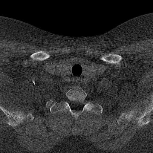 Ameloblastoma (Radiopaedia 38520-40623 Axial bone window 67).png