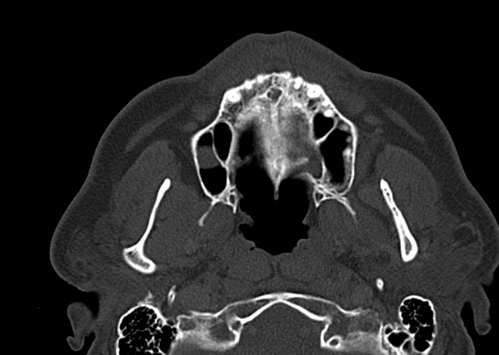 Ameloblastoma (Radiopaedia 38520-40623 D 20).png