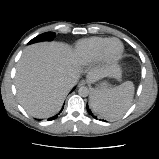 Amoebic liver abscesses (Radiopaedia 55536-62009 Axial C+ delayed 13).jpg