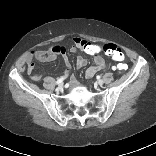 Ampullary adenocarcinoma (Radiopaedia 34013-35237 C 40).png