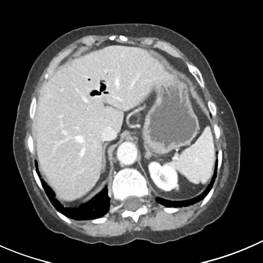 Ampullary adenocarcinoma (Radiopaedia 34013-35237 C 8).png