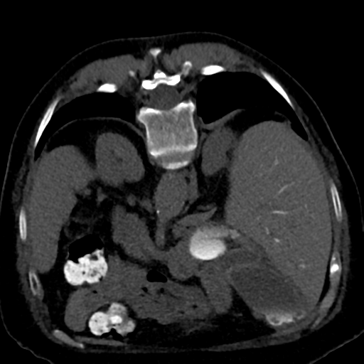 Ampullary adenocarcinoma (Radiopaedia 34013-35241 C 35).png