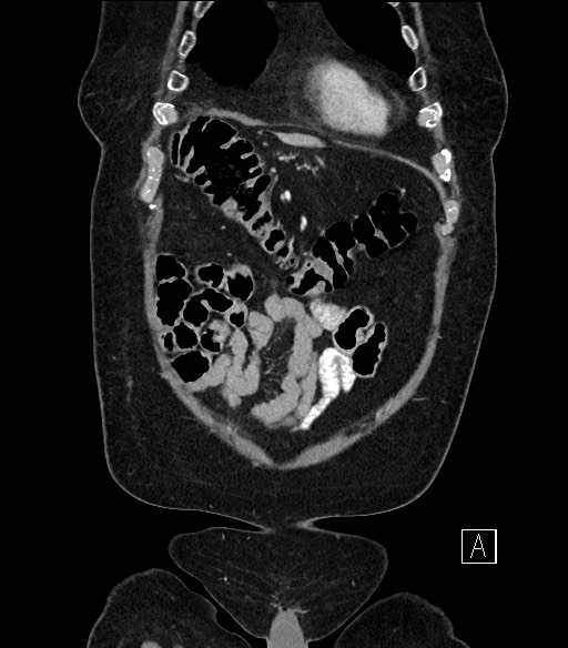 Ampullary adenocarcinoma (Radiopaedia 59373-66734 D 7).jpg