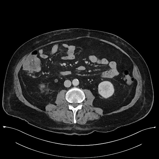 Ampullary adenocarcinoma (Radiopaedia 59373-66737 A 90).jpg