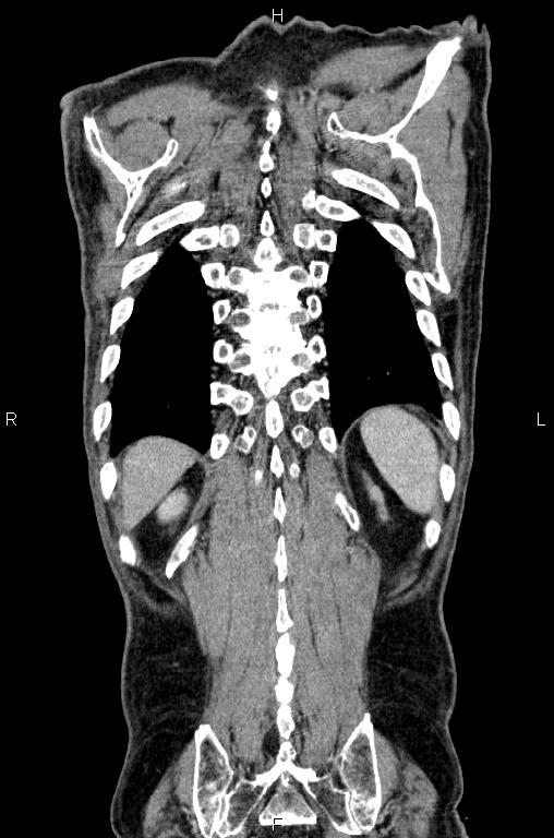 Ampullary adenocarcinoma (Radiopaedia 86093-102033 D 55).jpg